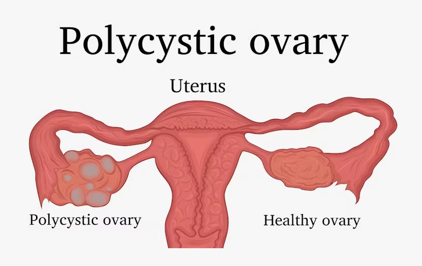 polycystic ovary syndrome symptoms